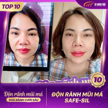 ĐỘN RÃNH MŨI MÁ